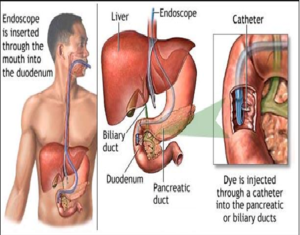 Endoscopic Retrograde Cholangio Pancreatography