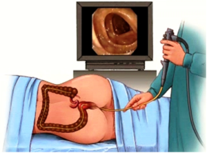 LOWER GI ENDOSCOPY / COLONOSCOPY