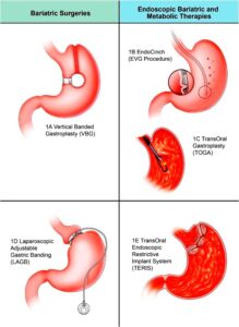 Endoscopic Bariatric Interventions