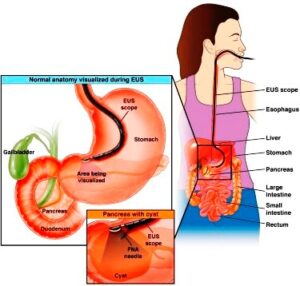 Endoscopic-Ultrasound-(EUS)