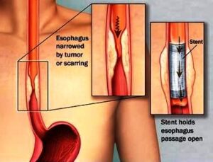 Oesophageal-Stenting-Pyloric-Stenting-Colonic-Stenting