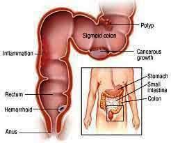 SIGMOIDOSCOPY TREATMENT