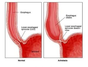 Achalasia-Cardia-Treatments-in-kalyan