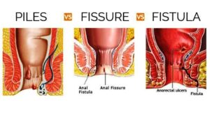 endoscopic piles procedures stapler hemorrhoids surgery