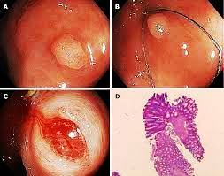 polyps-and-tumors-endoscopic-reactions