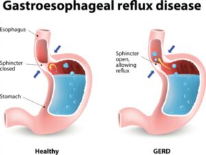 Gastroesophageal-Reflux
